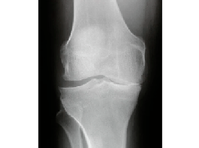 Diagnostic de l'arthrose de l'articulation du genou