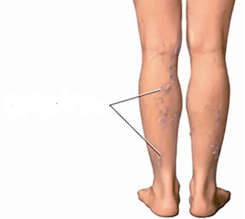 Les conséquences de l'arthrose du genou