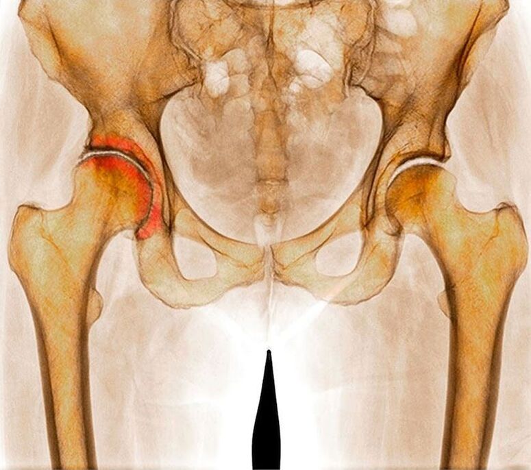 Arthrose de l'articulation de la hanche