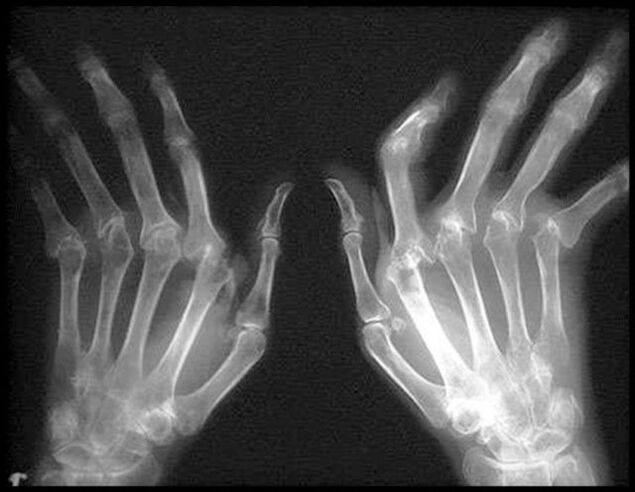 Picture X-Ray des mains affectées par l'arthrose