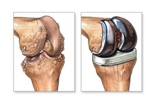 remplacement du genou pour arthrose