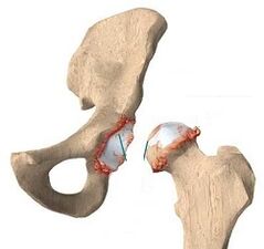 Les raisons du développement de l'arthrose de l'articulation de la hanche