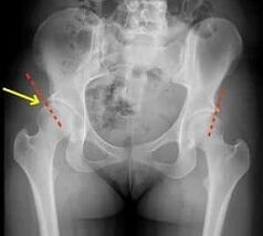 Méthodes de traitement de l'arthrose de l'articulation de la hanche