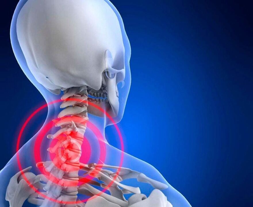 Douleur au cou avec ostéochondrose cervicale