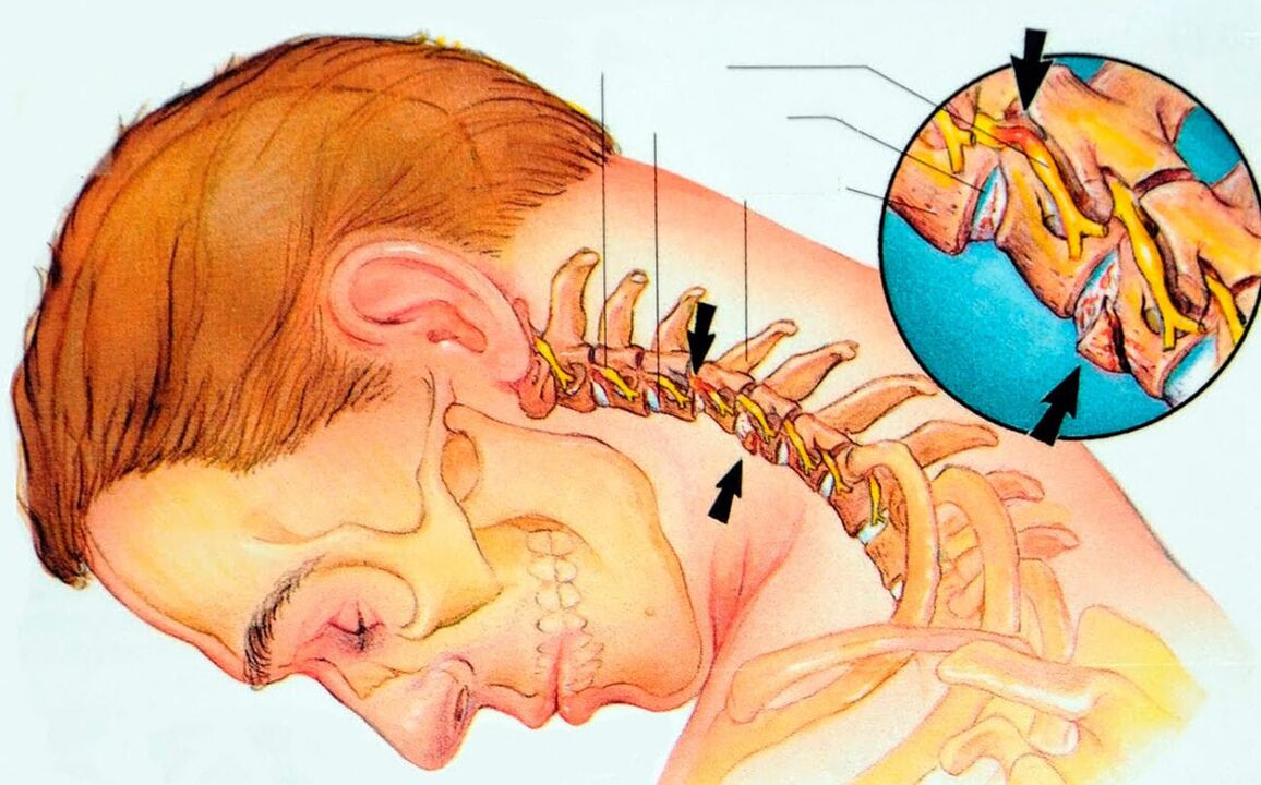 Qu'est-ce que l'ostéochondose cervicale
