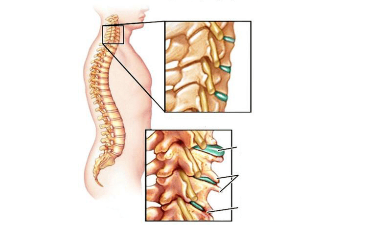 Syndromes d'ostéochondrose