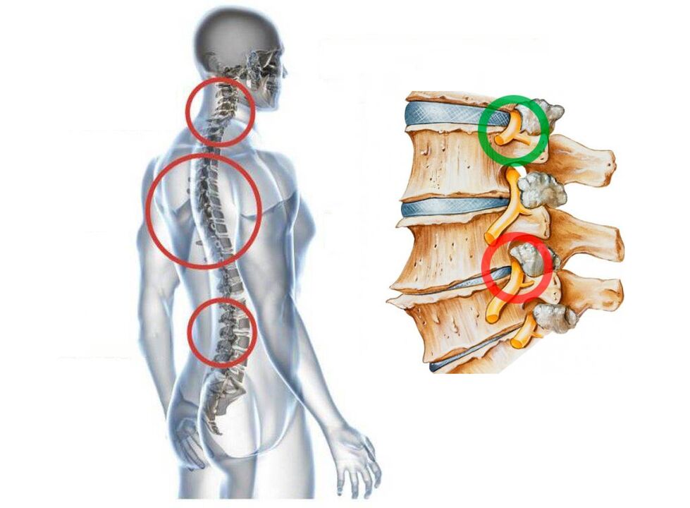 À quoi ressemble l'ostéochondrose cervicale des vertèbres