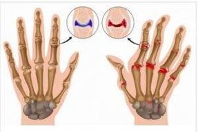 différences entre l'arthrite et l'arthrose des mains