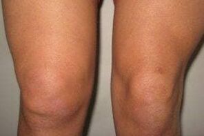 inflammation de l'articulation du genou avec arthrite et arthrose