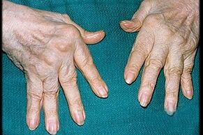 symptômes d'arthrite dans les doigts