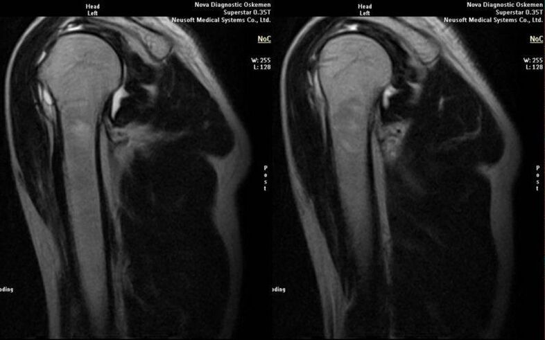 arthrose de l'articulation de l'épaule à la radiographie